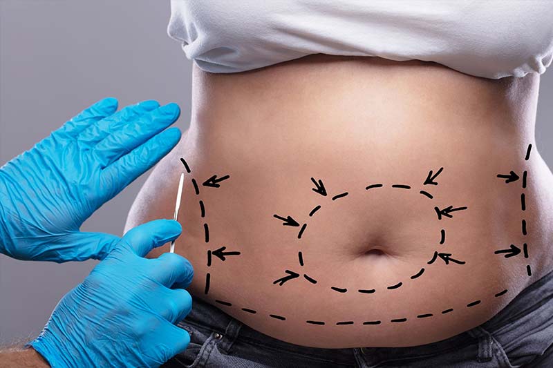 Post Tummy Tuck / Mommy Makeover